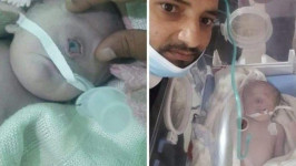 Bayi Bermata Satu Pernah Lahir di Indonesia, Hanya Bertahan 7 Hari