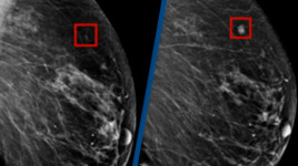 AI Sukses Deteksi Sel Kanker Payudara 4 Tahun Sebelum Mulai Tumbuh