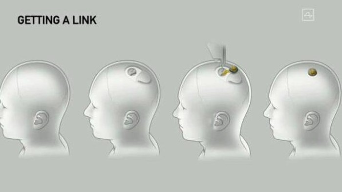 Sejarah! Elon Musk Diizinkan Tanam Chip di Otak Manusia
